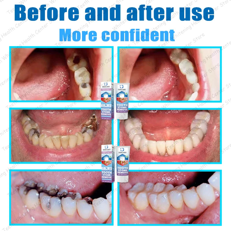 Contains probiotics to repair tooth decay and clean teeth